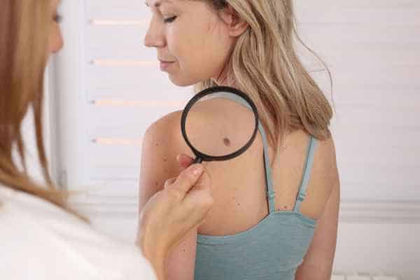 What Are Traditional Skin Lesion Removal Methods Hampshire?