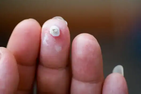 Image of white wart before cryopen treatment Hampshire