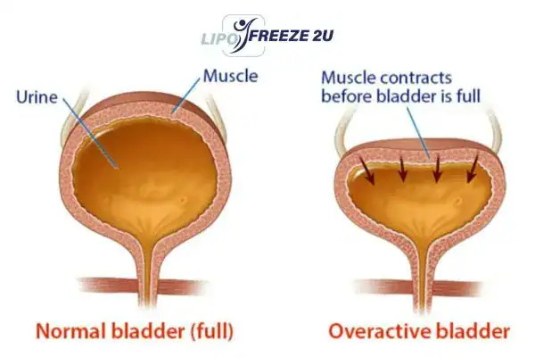 diagram of overactive bladder treatment Hampshire
