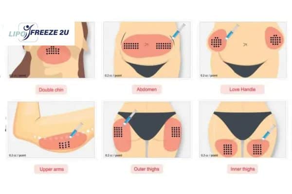 Benefits of Choosing Aqualyx for Fat Reduction Hampshire