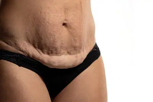 loose skin after weight loss injections Hampshire