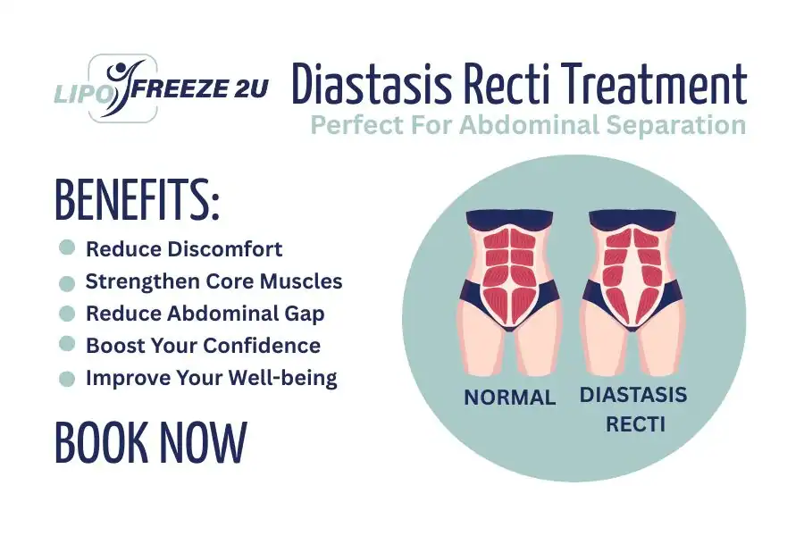 How Long Will It Take to See Improvements in Diastasis Recti Hampshire