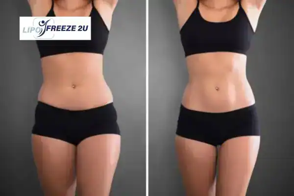 How Can LIPO FREEZE 2U Support Your Post-Pregnancy Body Recovery Hampshire?