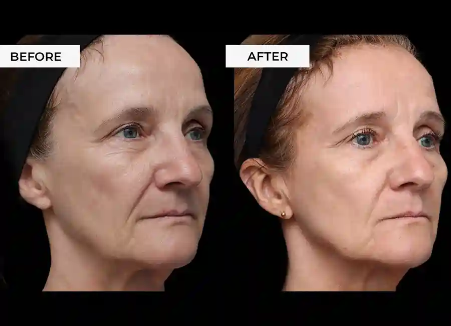 How Many RF Microneedling Sessions Will You Need to See a Difference Hampshire?