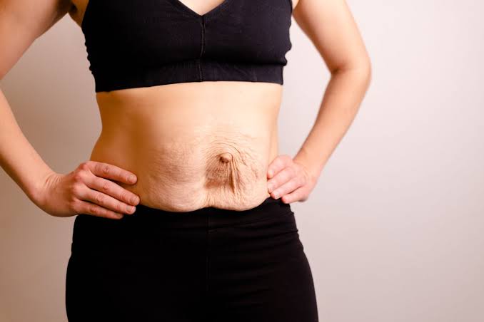 Is Surgery Really the Only Way to Repair Diastasis Recti Hampshire?