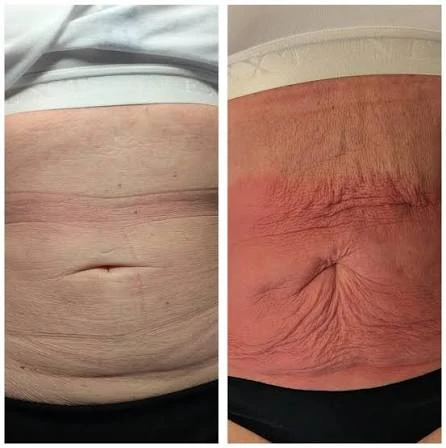 How Does RF Microneedling Improve Crepey, Thin and Uneven Skin Texture Hampshire?
