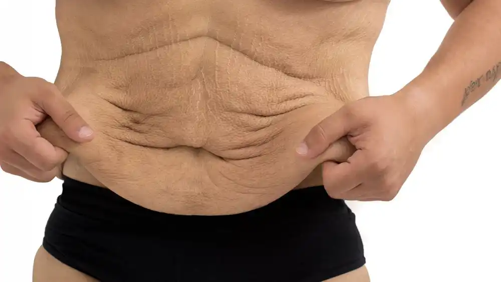 RF Microneedling for Loose Skin: How Can It Help Tighten and Reshape the Skin Hampshire?
